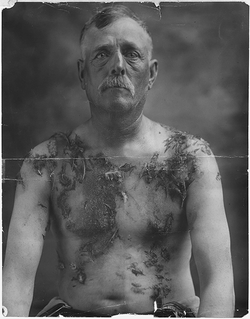 Photograph of a man facing the camera directly. His chest and shoulders are coated with tar and feathers.